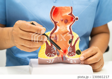 Asian doctor with rectum and hemorrhoid human anatomy model at hospital, inflamed vascular structure. Asian doctor with rectum and hemorrhoid human anatomy model at hospital, inflamed vascular structure. 130981217