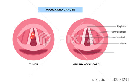 Vocal cord cancer medical poster Vocal cord cancer medical poster 130993291