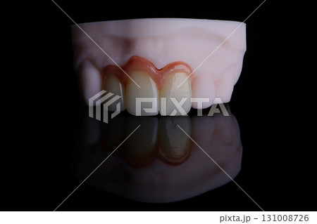 High-quality three dental crowns made of zirconium for fixation to the frontal teeth of upper jaw. High-quality three dental crowns made of zirconium for fixation to the frontal teeth of upper jaw. 131008726