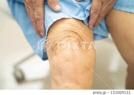 Asian elderly woman patient with scar knee replacement surgery in hospital. Asian elderly woman patient with scar knee replacement surgery in hospital. 131009131