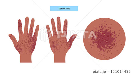 Dermatitis medical poster 131014453