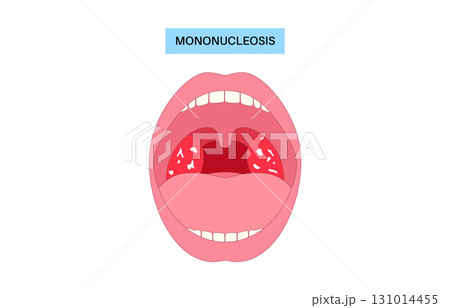 Mononucleosis symptoms poster Mononucleosis symptoms poster 131014455