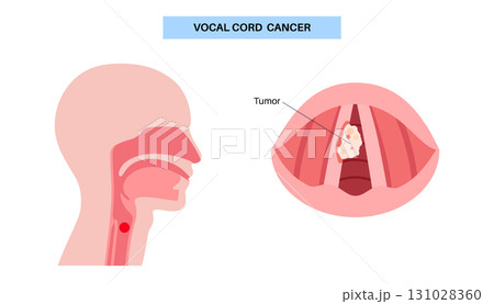 Vocal cord cancer medical poster Vocal cord cancer medical poster 131028360