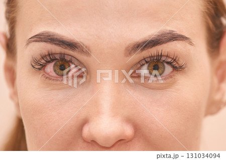 Young caucasian female with bloodshot eye showing symptoms of conjunctivitis 131034094