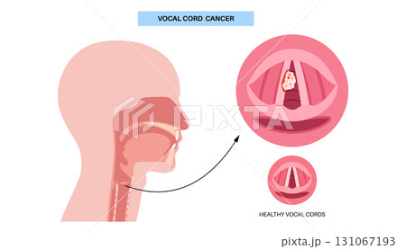 Vocal cord cancer medical poster Vocal cord cancer medical poster 131067193
