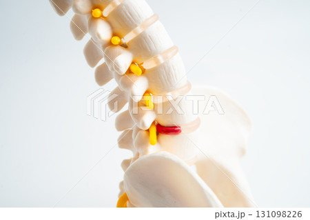 Lumbar spine displaced herniated disc fragment, spinal nerve and bone. Model for treatment medical in the orthopedic department. Lumbar spine displaced herniated disc fragment, spinal nerve and bone. Model for treatment medical in the orthopedic department. 131098226