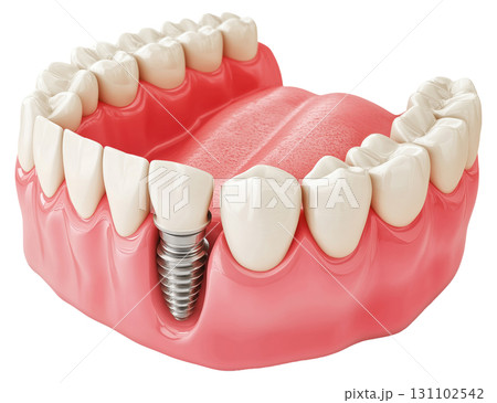 Dental Implant Model 131102542