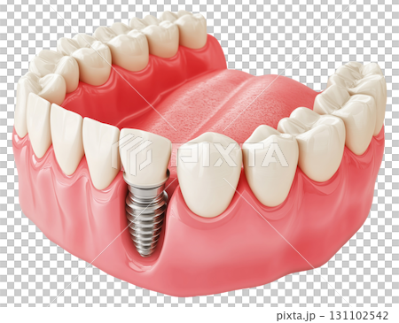 Dental Implant Model 131102542