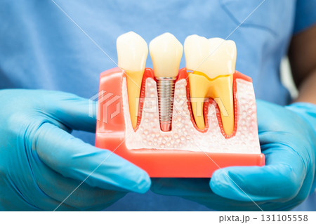 Dentist holding dental implant, artificial tooth roots into jaw, root canal of dental treatment, gum disease, teeth model for dentist. 131105558