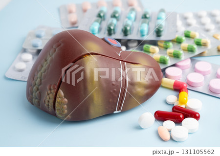 Liver model with pill drug treatment, Cirrhosis, Liver cancer, fatty liver. Liver model with pill drug treatment, Cirrhosis, Liver cancer, fatty liver. 131105562