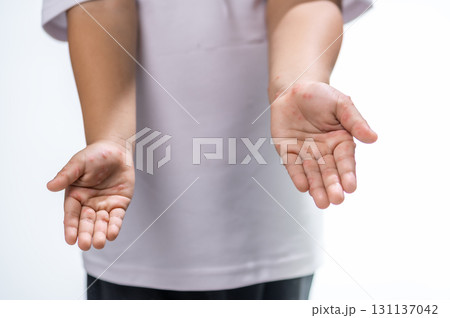 Hand, foot and mouth disease HFMD Human hand of scarlet fever in coxsackievirus palmarosa virus and child hand on white background 131137042