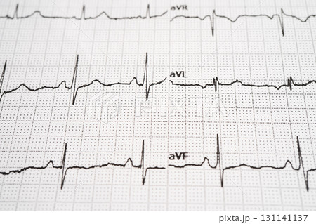 Red heart on electrocardiogram ECG with red heart, heart wave, heart attack, cardiogram report. Red heart on electrocardiogram ECG with red heart, heart wave, heart attack, cardiogram report. 131141137
