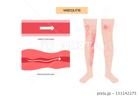 Vasculitis medical poster Vasculitis medical poster 131142275