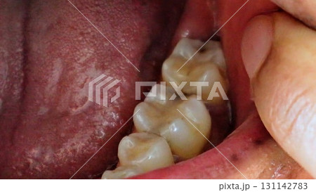 虫歯のクローズアップ 131142783