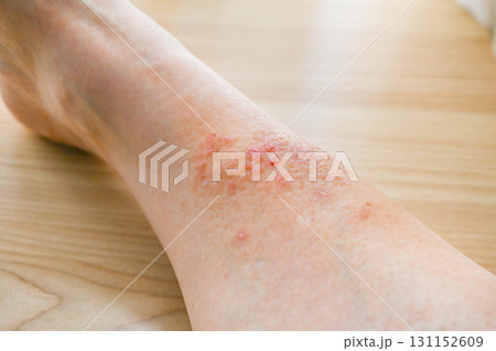 保湿クリームを塗った足の湿疹 131152609