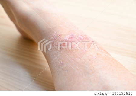 足の湿疹 131152610