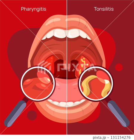 Detailed Illustrations of Pharyngitis and Tonsillitis Detailed Illustrations of Pharyngitis and Tonsillitis 131154276