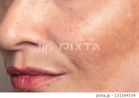 Cropped close up photo Woman with pigmentation, melasma, freckles, age spots photo. 131164534