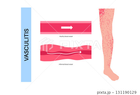 Vasculitis medical poster Vasculitis medical poster 131190129