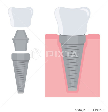 Dental implant. Screw prosthesis, Illustration of dental implantation,orthodontic dental implantation 131194596