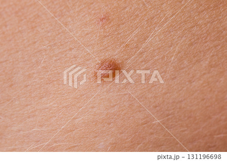 Closeup brown mole on caucasian woman skin. 131196698
