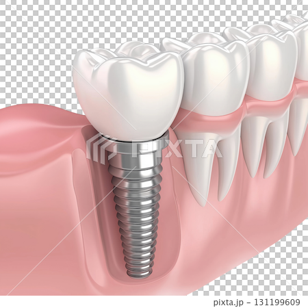 Dental Implant Illustration Dental Implant Illustration 131199609