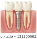 Dental Implant 131200062