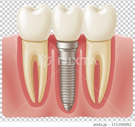 Dental Implant 131200062