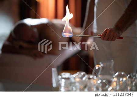 Close up of a traditional fire cupping therapy session with glass cups placed on a patients back and therapist using fire to create suction, promoting relaxation and healing. 131237047