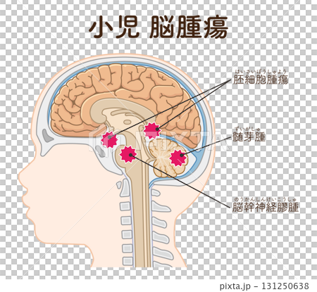 兒童腦腫瘤 兒童腦腫瘤 131250638
