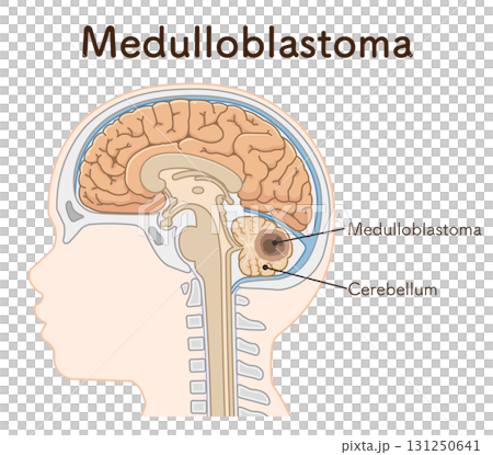 Childhood brain tumors 131250641