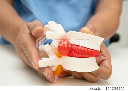 Asian doctor holding spinal nerve and bone model, Lumbar spine displaced herniated disc fragment for treatment medical in the orthopedic department. Asian doctor holding spinal nerve and bone model, Lumbar spine displaced herniated disc fragment for treatment medical in the orthopedic department. 131254332