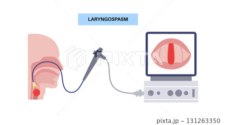 Laryngospasm medical poster Laryngospasm medical poster 131263350
