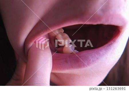 Girl shows pink tooth with caries and cured with use resorcinol-formalin paste. 131263691