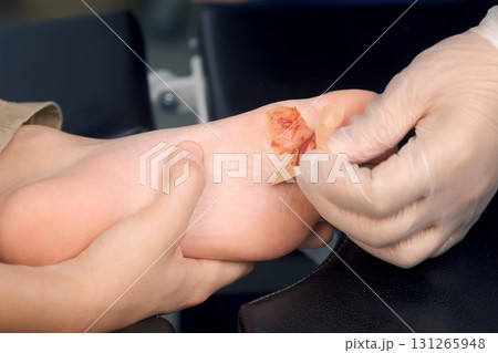 Surgeon is changing the wound on boy's foot with a plaster after the operation. Surgeon is changing the wound on boy's foot with a plaster after the operation. 131265948