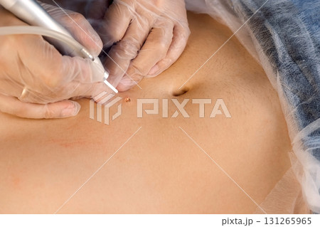 Surgeon removing big mole on man's stomach using laser in hospital, closeup. Surgeon removing big mole on man's stomach using laser in hospital, closeup. 131265965