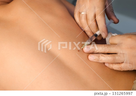 Surgeon gives injection of local anesthesia during laser removing mole on back. 131265997