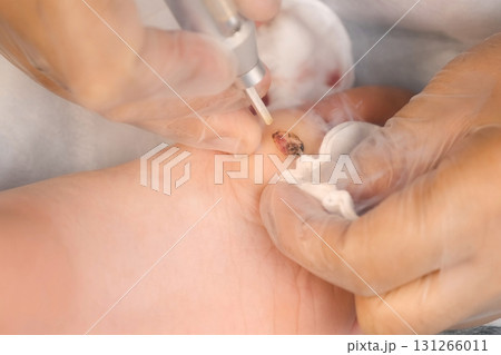 Surgeon removing wart on boy's foot using laser in hospital, hands closeup. 131266011