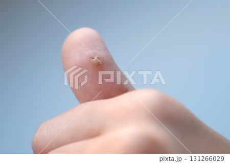 Big wart on human thumb finger before laser removing, closeup view. Big wart on human thumb finger before laser removing, closeup view. 131266029