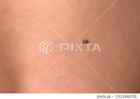 Boy's white skin in back with big brown mole before laser removing, closeup. Boy's white skin in back with big brown mole before laser removing, closeup. 131266030