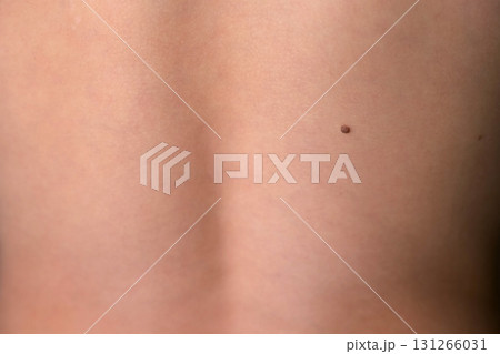 Boy's white skin in back with big brown mole before laser removing. Boy's white skin in back with big brown mole before laser removing. 131266031