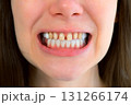 Mouth of young woman with yellow bad teeth preparing to install ceramic veneers. 131266174