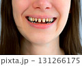 Mouth of young scary woman with yellow bad teeth smiling looking at camera. 131266175