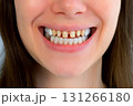 Smiling mouth of young woman with yellow bad teeth prosthetics of teeth concept. 131266180