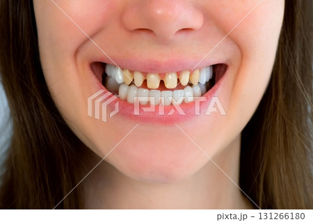 Smiling mouth of young woman with yellow bad teeth prosthetics of teeth concept. Smiling mouth of young woman with yellow bad teeth prosthetics of teeth concept. 131266180