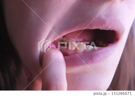 Pink tooth with caries and cured with using resorcinol-formalin paste. 131266871