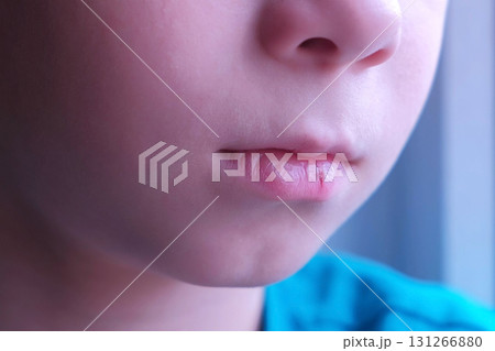 Child boy with cracked dry lip, mouth closeup. 131266880