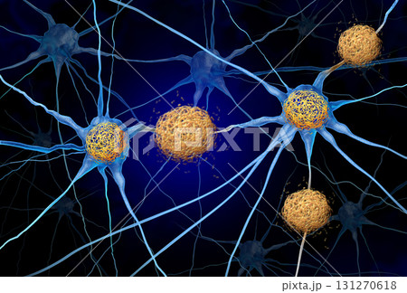 Tau Tangles And Amyloid Beta Tau Tangles And Amyloid Beta 131270618