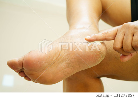 Asian woman check feet with crack and dry heel skin, Diabetic Foot. 131278857