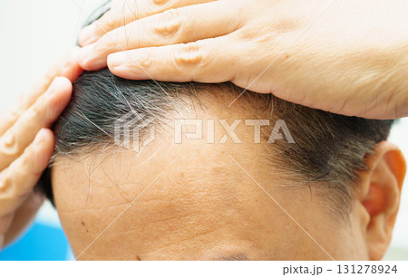 Bald head in man, hair loss treatment health problem. 131278924